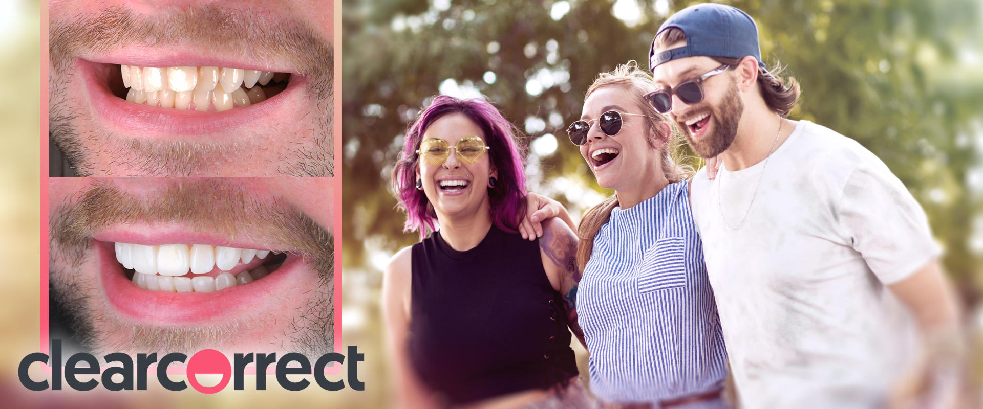 ClearCorrect Align, Bleach & Bond (ABB)